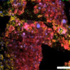 Spatial_melanoma
